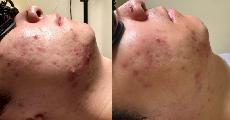 Ultimate Skin Renewal treatment at Sonder Esthetics