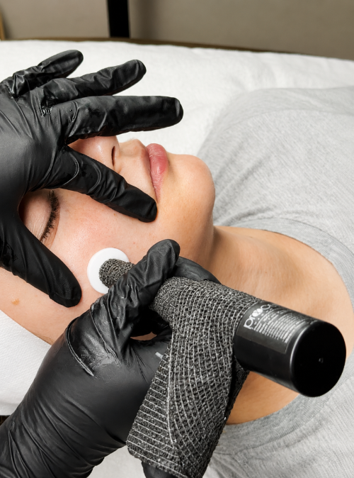 Procell Microchanneling treatment at Sonder Esthetics Prosper TX