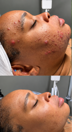 Acne Consultation before and after at Sonder Esthetics