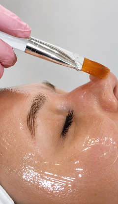 Chemical Peel
